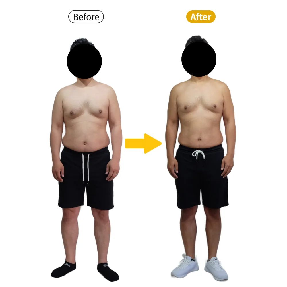 S.M様のビフォーアフター（正面から）。左がBefore、右がAfter
